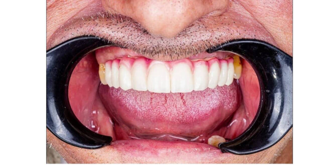 FULL MOUTH OCCLUSION RECONSTRUCTION IMPLANT CASE