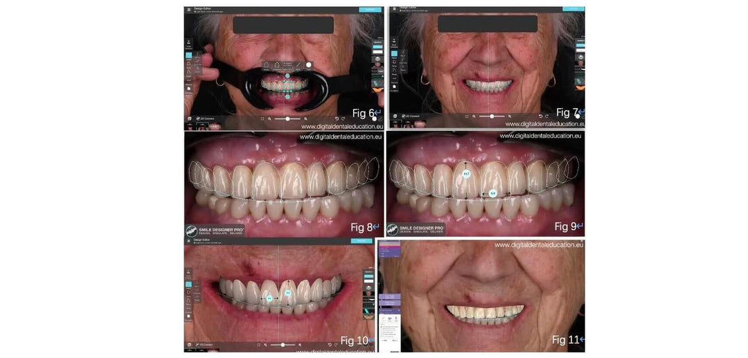 CASE STUDY: FULL MOUTH REHABILITATION USING OUR DENTAL DS-EX Series SCANNERS