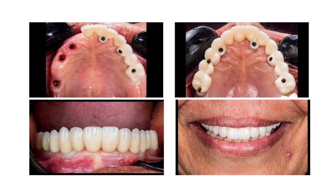 OCCLUSION RECONSTRUCTION OF UPPER JAW USING DIGITAL IMPLANTS AND RESTORATIONS