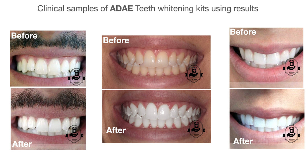 Teeth whitening Osram light AD013 - ADAE Dental Online Store
