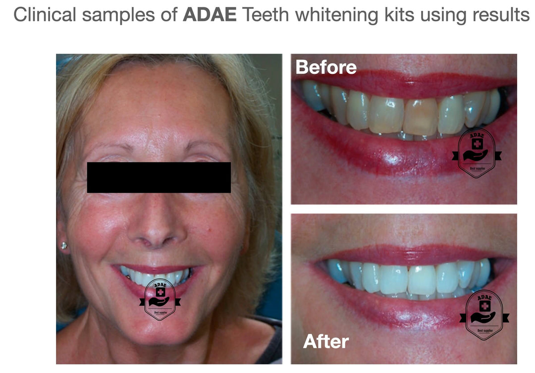 AD001 professional teeth whitening kit for dental clinics - ADAE Dental Online Store
