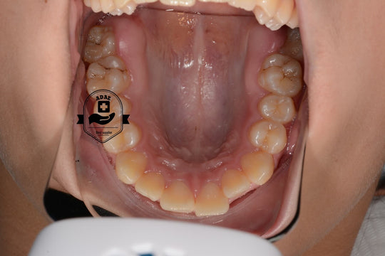ADAE dental intraoral LED fog free photo system kit - ADAE Dental Online Store