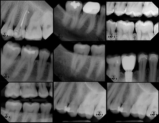 ADAE Refine dental X-Ray sensor (R1-R2) with Twain Driver(Upgraded version)