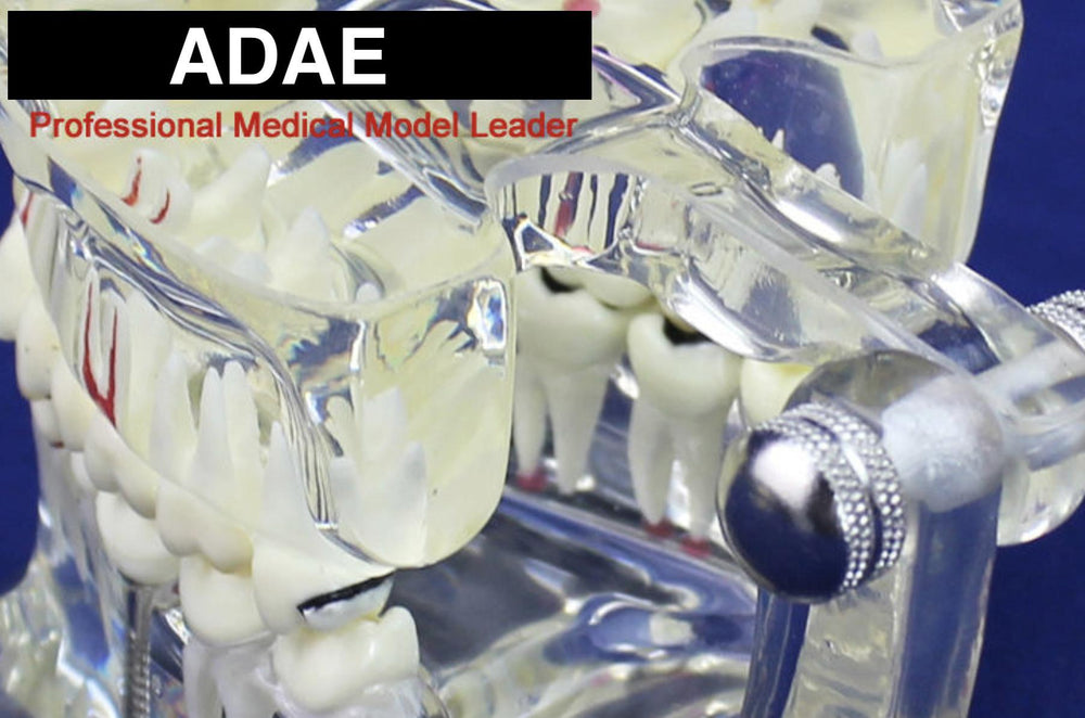ADAE AD018 transparent dental pathological illustration model with implant tooth - ADAE Dental Online Store