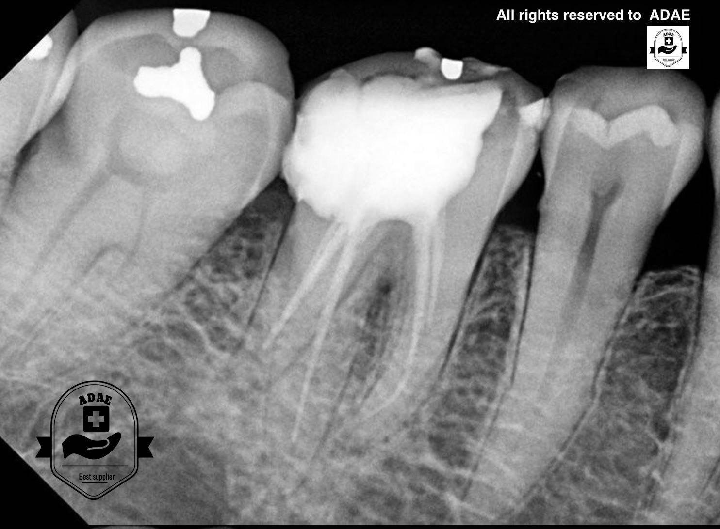ATECO sensor Xray sensor (UKmade)New upgraded version ADAE Dental